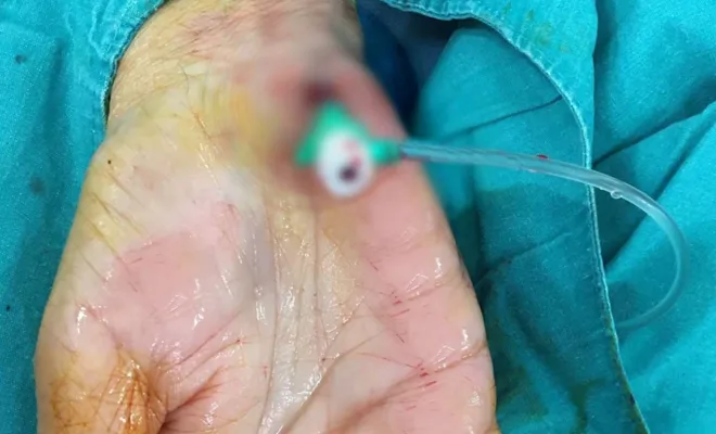 Elazığ’da avuç içinden anjiyo işlemi yapıldı 